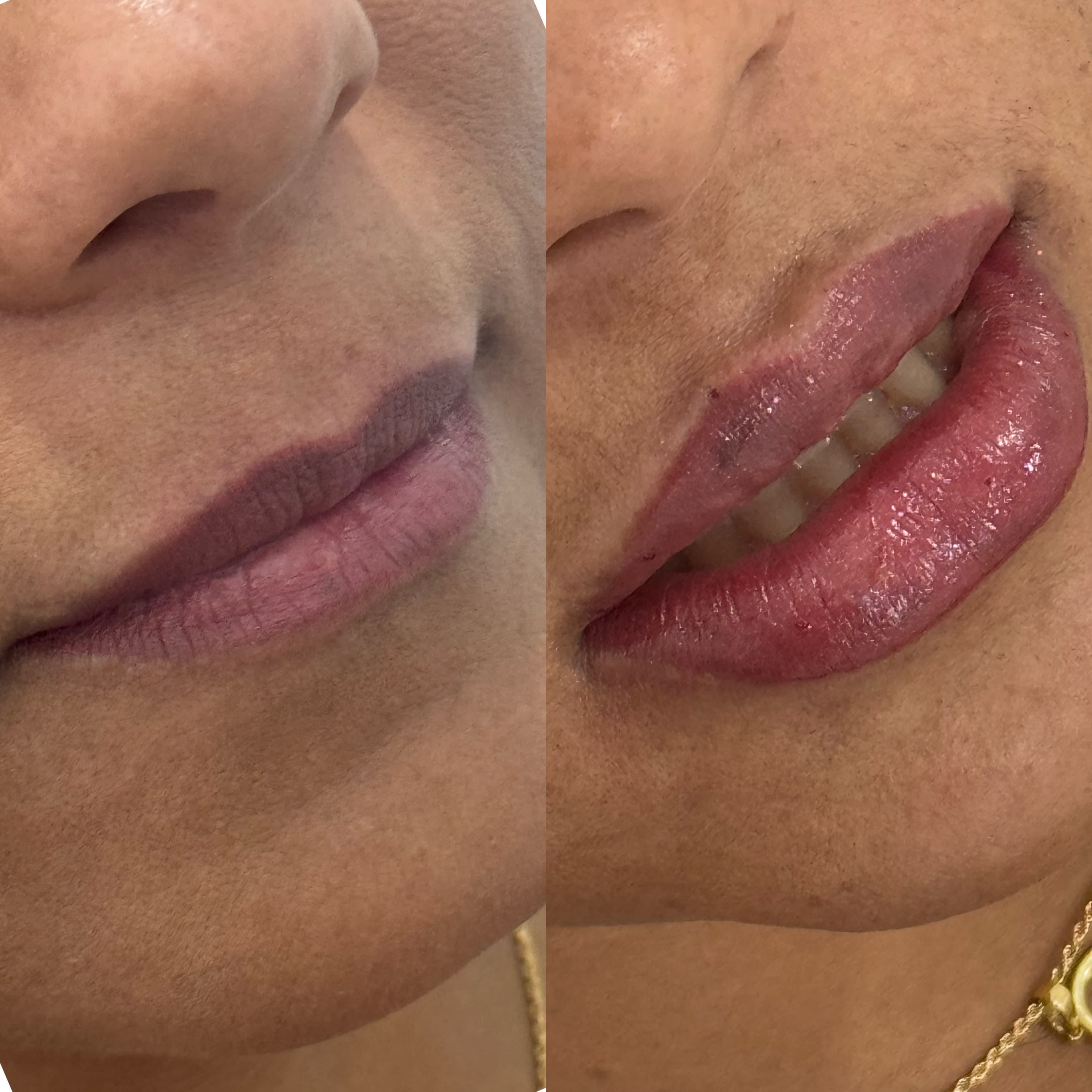 Antes e depois de preenchimento labial com ácido hialurónico, com contorno mais definido