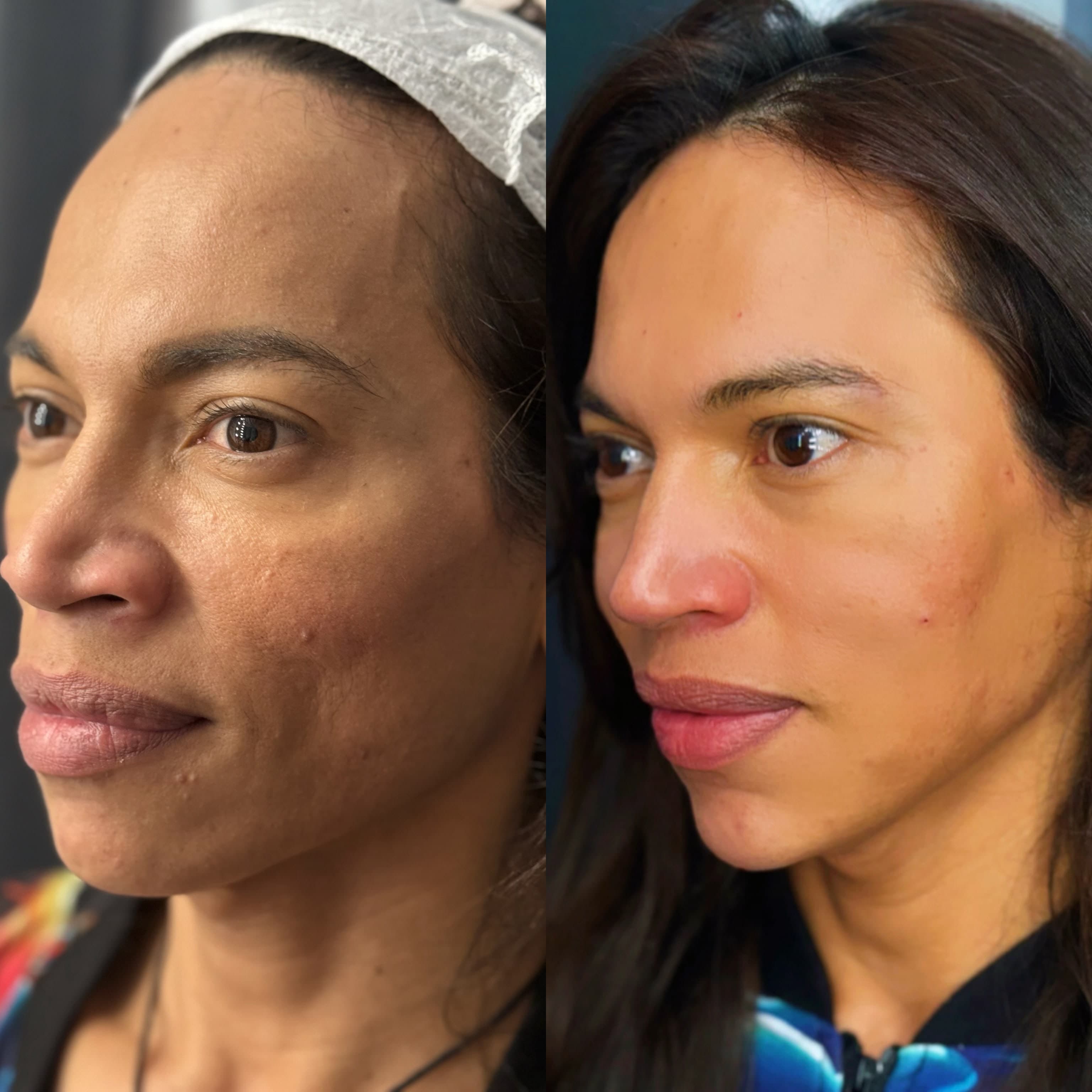 Antes e depois de harmonização facial, com textura de pele mais uniforme