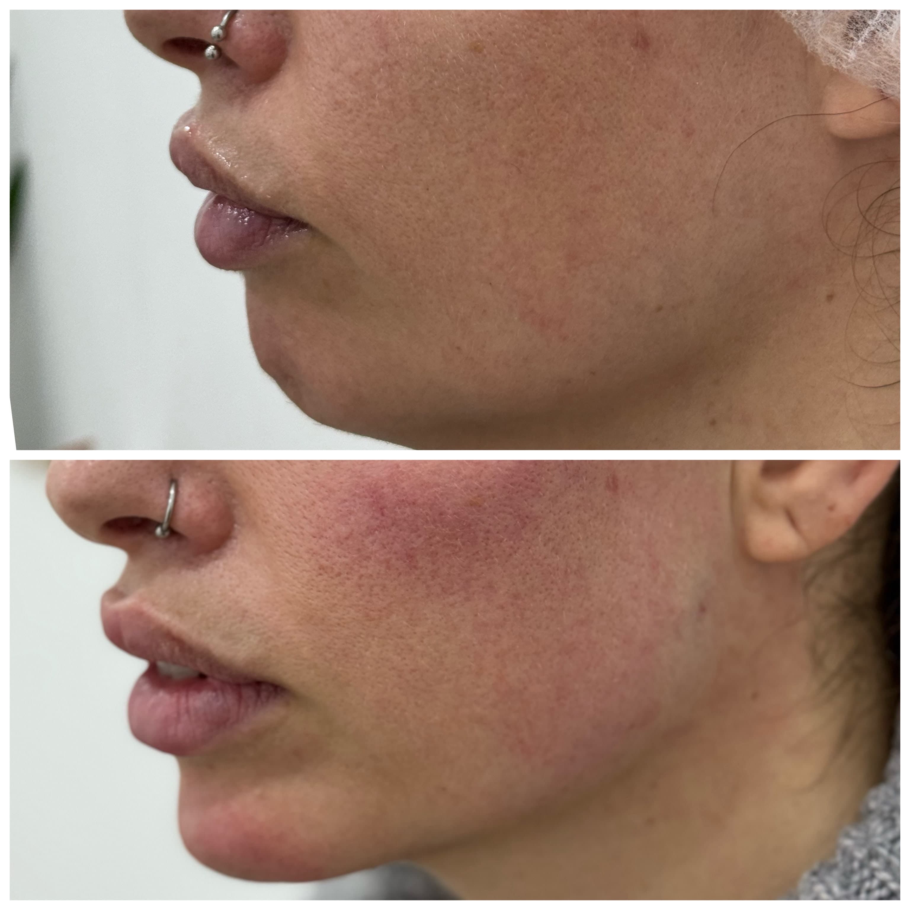Antes e depois de harmonização facial no contorno mandibular