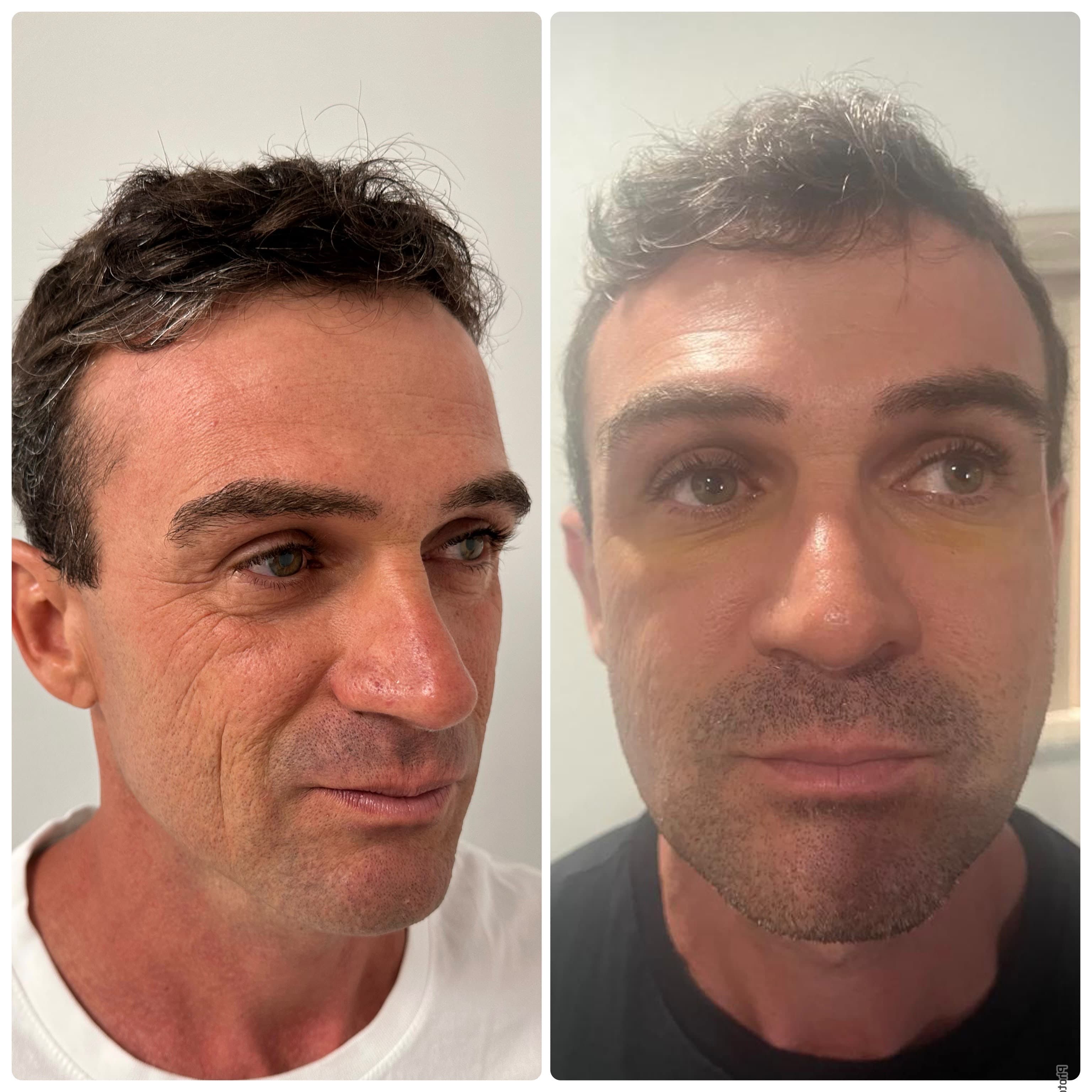 Antes e depois de preenchimento de olheiras num paciente masculino, em Lisboa