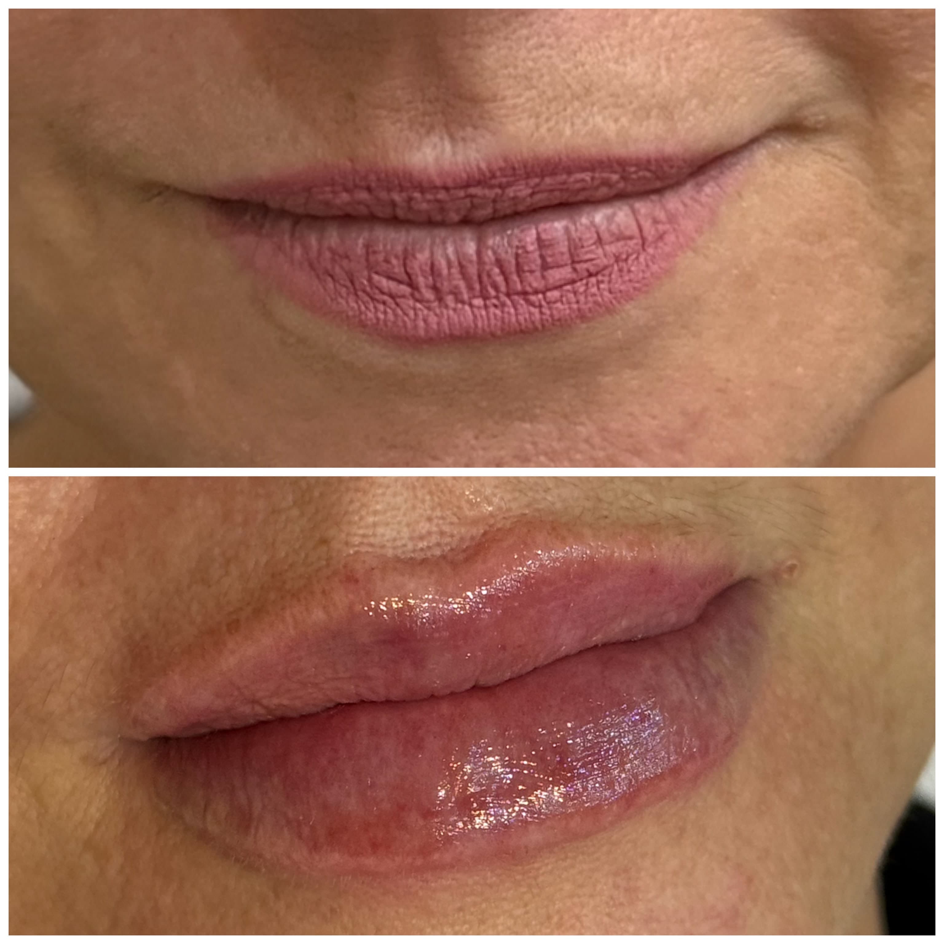 Antes e depois de preenchimento labial com ácido hialurónico, com mais volume e hidratação