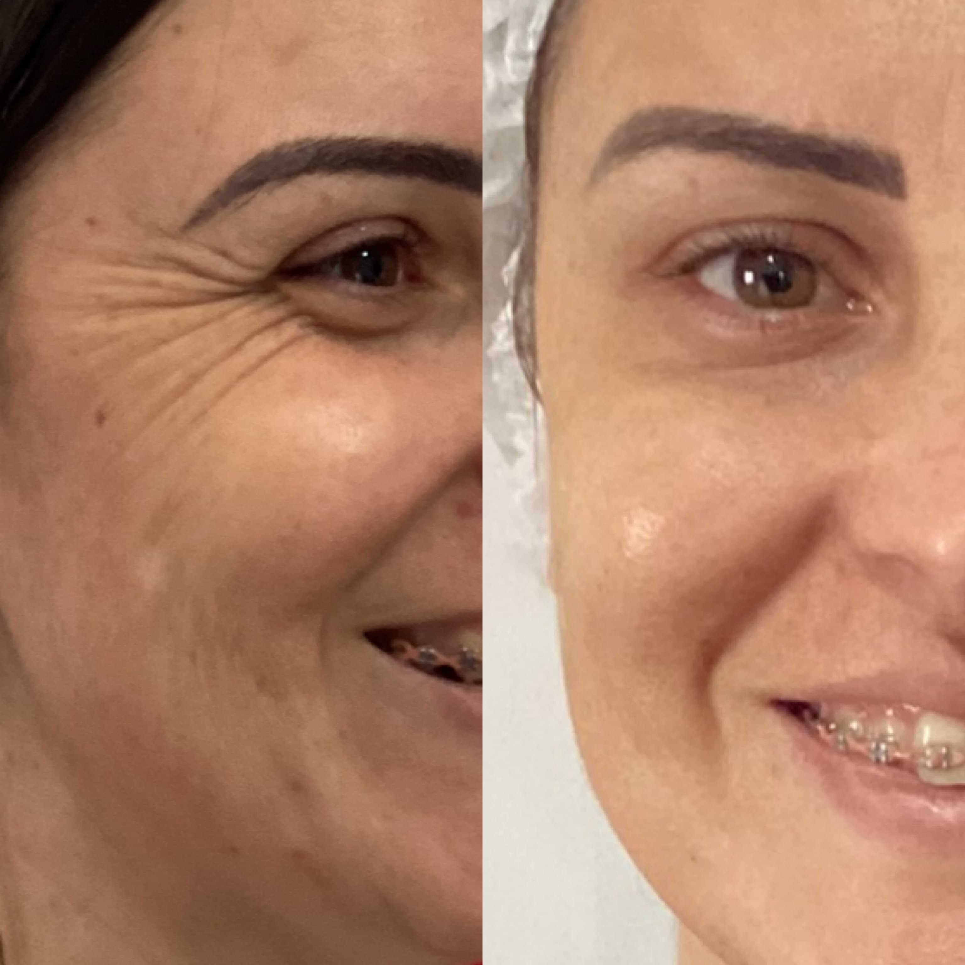 Antes e depois de toxina botulínica nas rugas perioculares de uma paciente da clínica em Odivelas